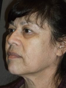 before neck lift left angle view of female patient 1629