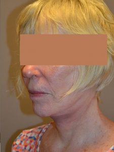 after neck lift angle view of female patient 1653