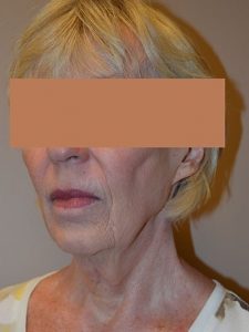 before neck lift angle view of female patient 1653