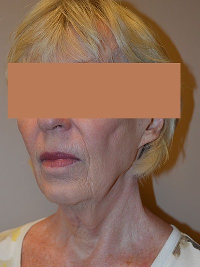 before neck lift angle view of female patient 1653