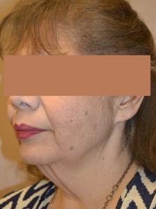 before neck lift angle view of female patient 1656