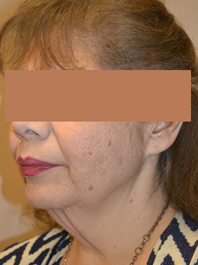 before neck lift angle view of female patient 1656