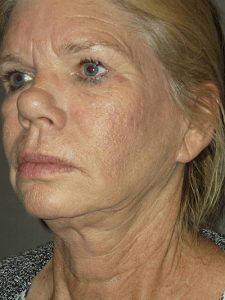 before neck lift left angle view of female patient 1676