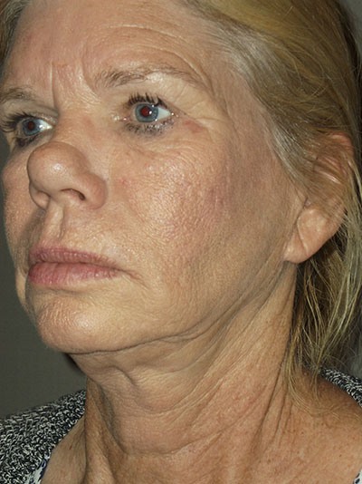before neck lift left angle view of female patient 1676