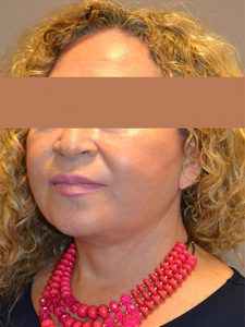 after neck lift left angle view of female patient 1696