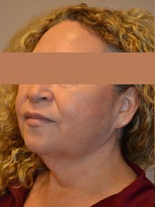 before neck lift left angle view of female patient 1696