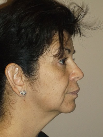 before neck lift right side view of female patient 1700