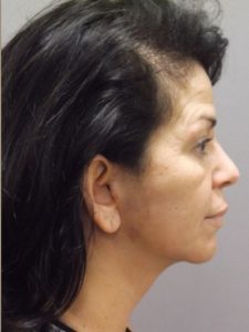 after neck lift right side view of female patient 1700