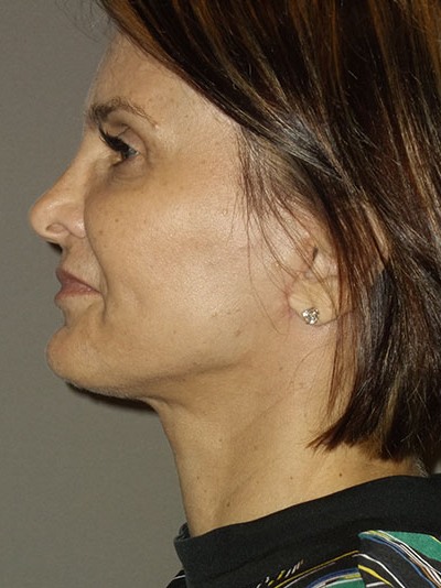 after neck lift left side view of female patient 1703