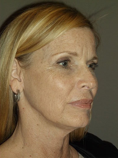 before neck lift right angle view of female patient 1707