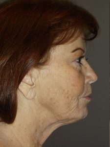before neck lift right side view of female patient 1710
