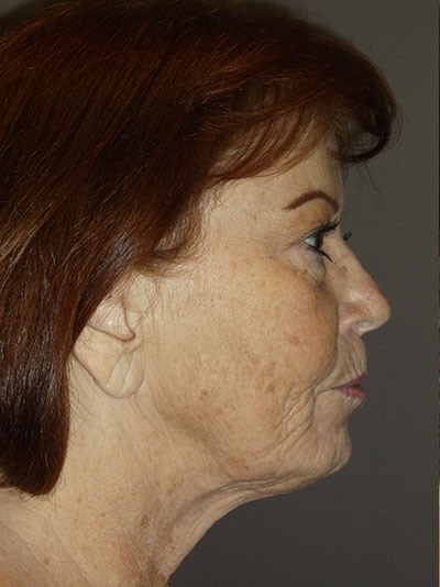 before neck lift right side view of female patient 1710