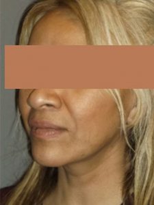 after neck lift left angle view of female patient 1748