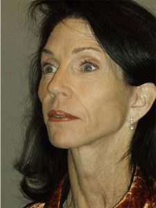 after neck lift left angle view of female patient 1762