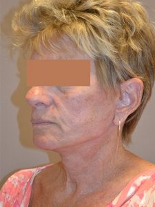 after neck lift left angle view of female patient 1792