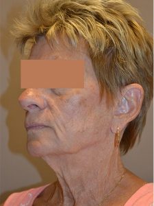 before neck lift left angle view of female patient 1792