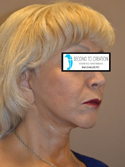 after neck lift right side view of female patient 1839
