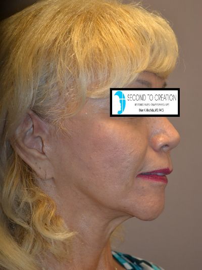 before neck lift right side view of female patient 1839
