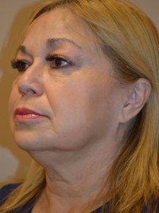 before neck lift left angle view of female patient 1842