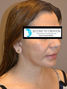 after neck lift right side view of female patient 1845