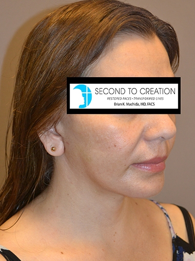 after neck lift right side view of female patient 1845