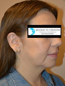 before neck lift right side view of female patient 1845