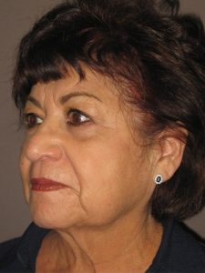 before neck lift left angle view of female patient 1855