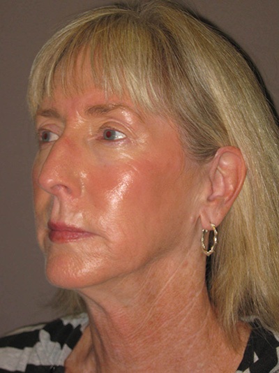 before neck lift left angle view of female patient 1863