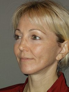 after neck lift left angle view female patient case 1869