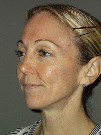 before neck lift left angle view female patient case 1869