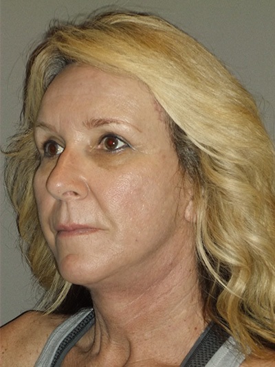 after neck lift left angle view female patient case 1872
