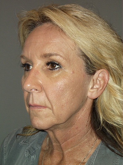 before neck lift left angle view female patient case 1872