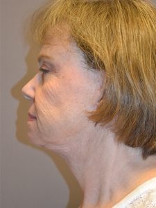 after neck lift left side view female patient case 1896