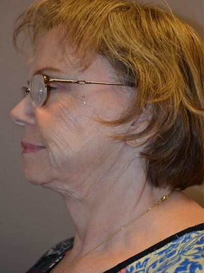 before neck lift left side view female patient case 1896