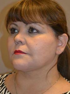 after neck lift left angle view female patient case 1973