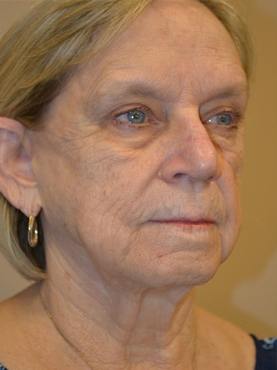 before neck lift right angle view female patient 39