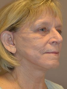 after neck lift right angle view female patient 39