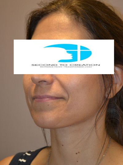 after neck lift left angle view female patient case 40