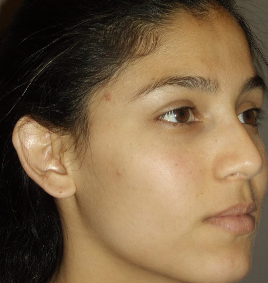 before otoplasty right angle view of female patient 1358