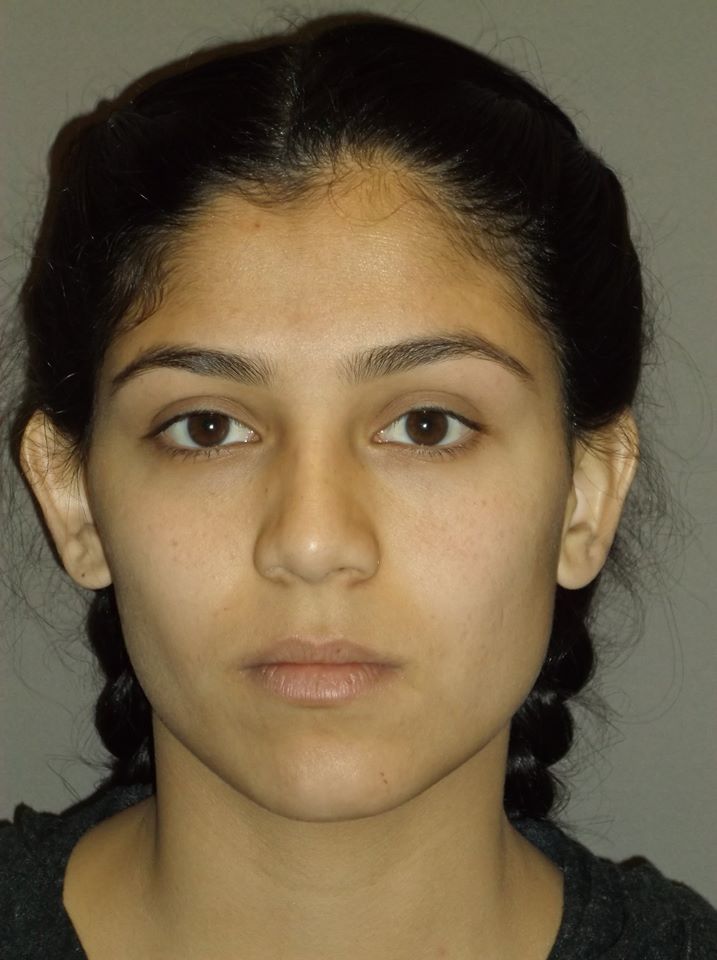 before otoplasty front view of female patient 1358