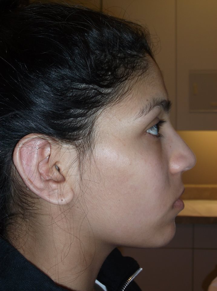 after otoplasty right side view of female patient 1358